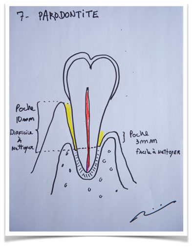 La gingivite et la parodontite chez clinique dentaire Villemaire à Sherbrooke