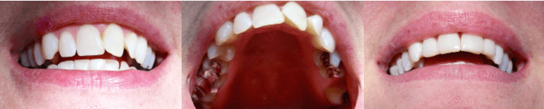 Le meilleur choix de traitement pour traiter une mauvaise occlusion est sans contredit l’orthodontie
